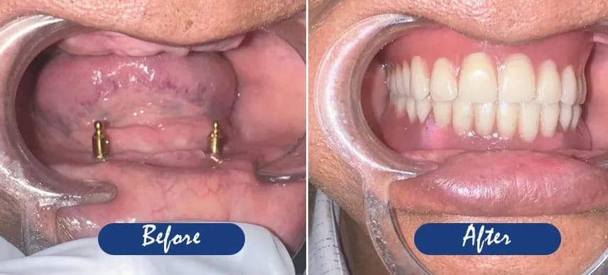 Best Implants Service Doctors Near Pimpri-Chinchwad, Pune – Sweet Smile Dental Clinic