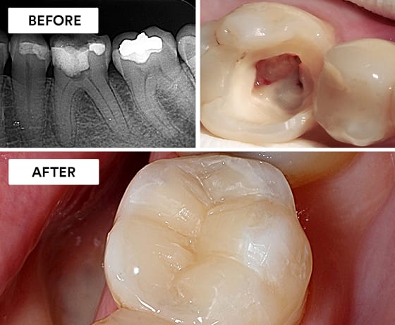 Best Root Canal Doctors in Pimpri Chinchwad – Sweet Smile Dental Clinic