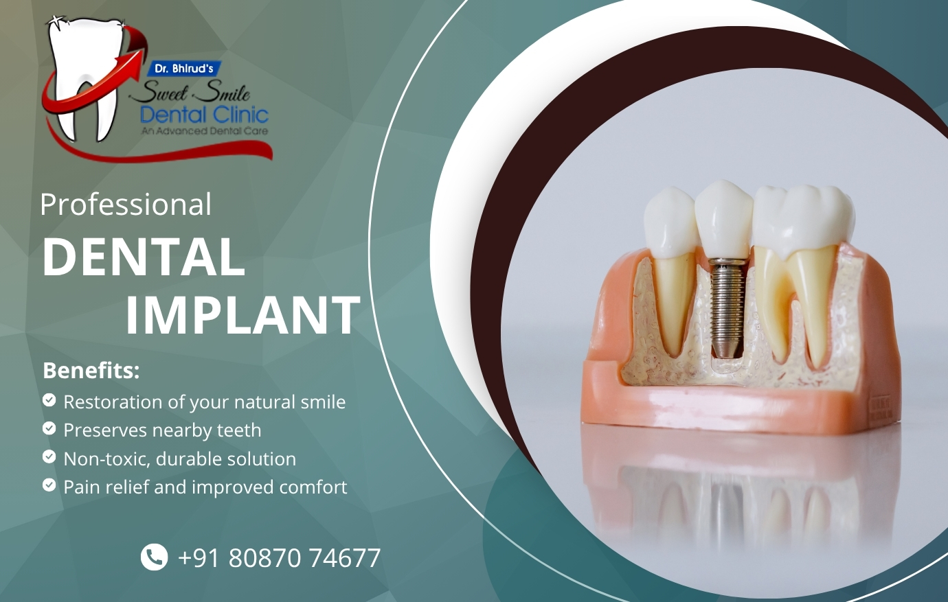 Dental implant treatment in Pimpri Chinchwad at Sweet Smile Dental Clinic