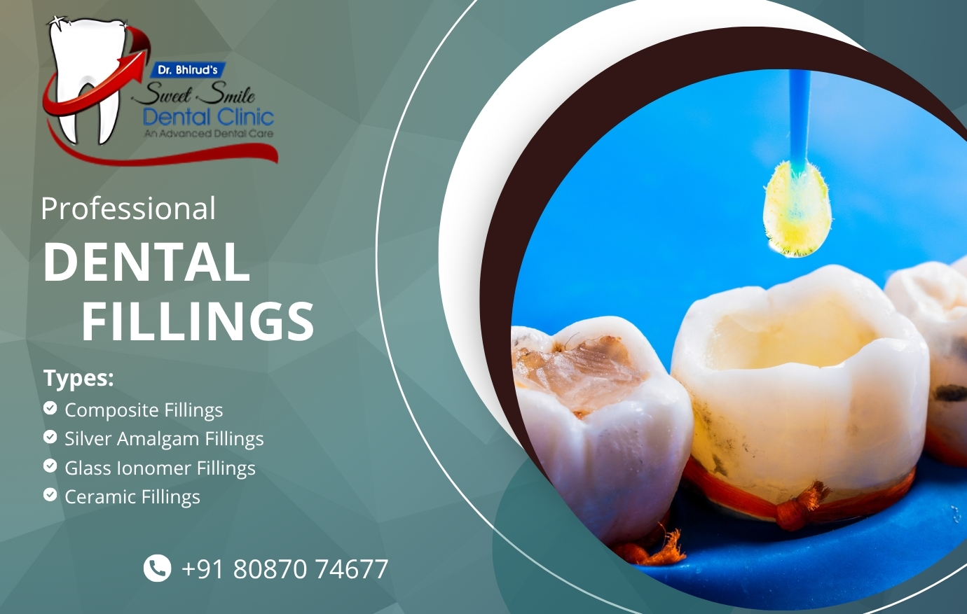 Dental Fillings