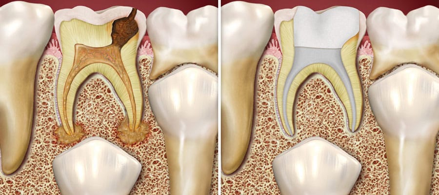 Painless Root Canal in Pimpri Chinchwad by Expert Dentists – Sweet Smile Dental Clinic