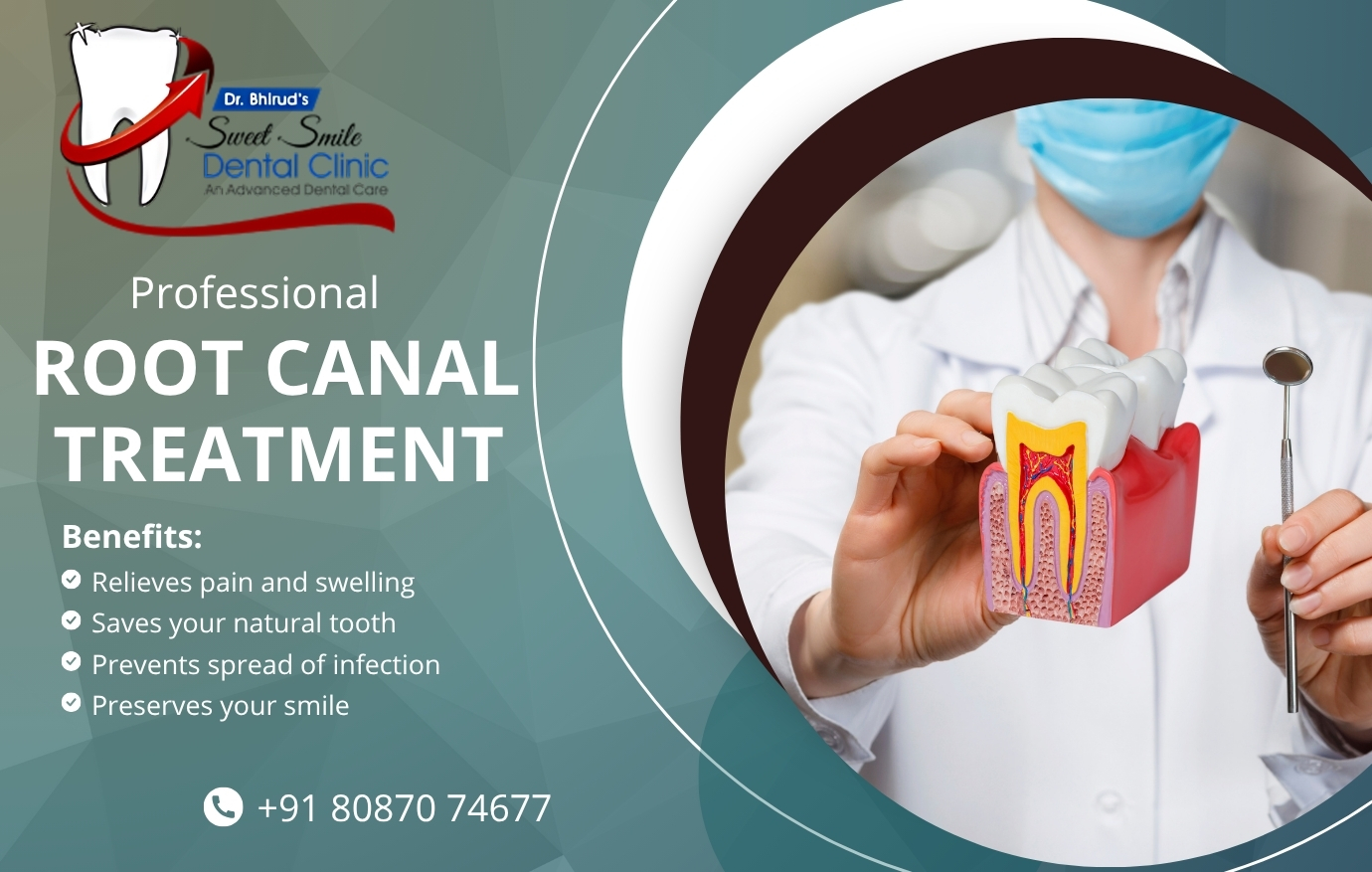 Root Canal Treatment in PCMC by Best Dentist – Sweet Smile Dental Clinic